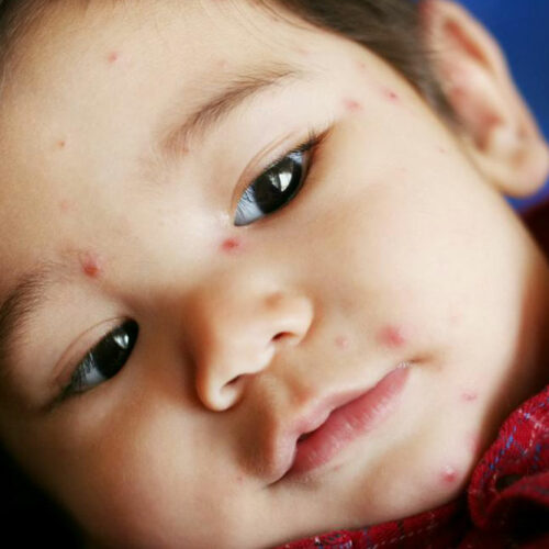 5 tell-tale signs of chickenpox you should know about