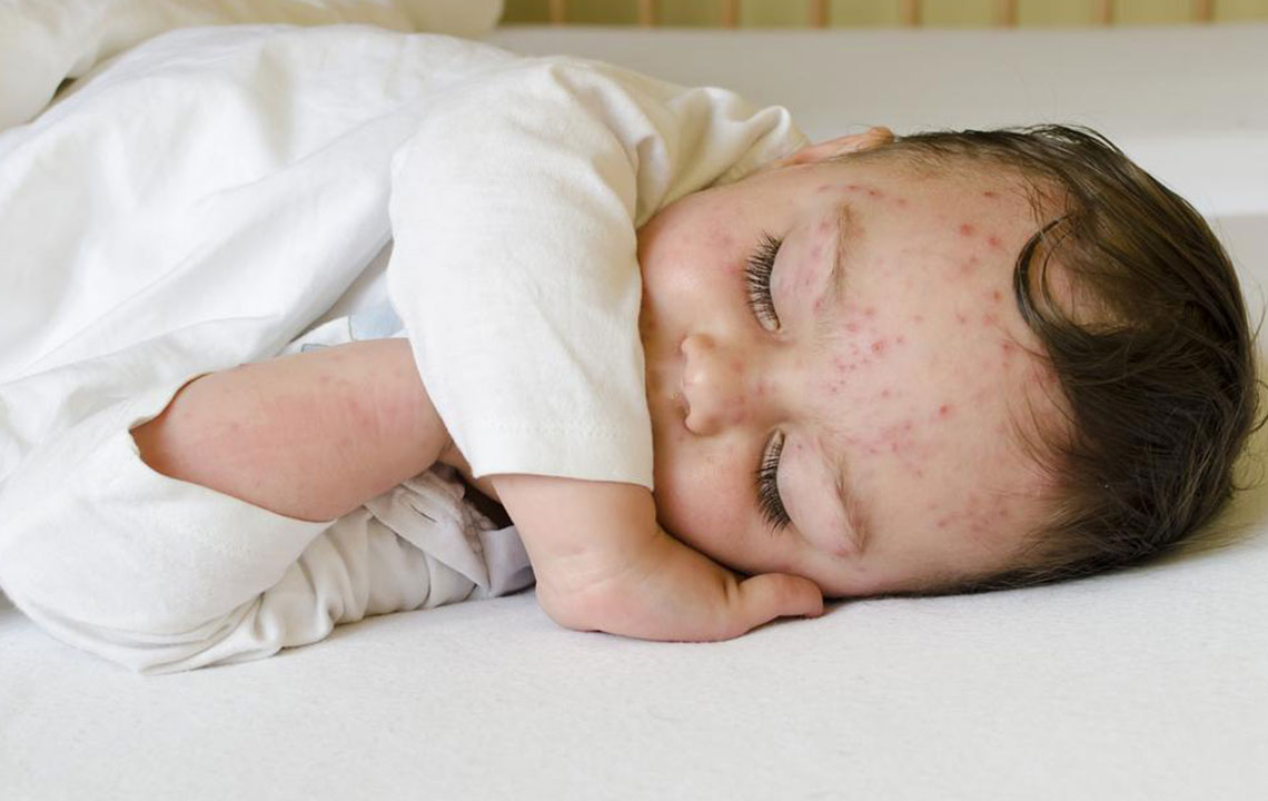 Here&#8217;s how to treat skin rashes in babies