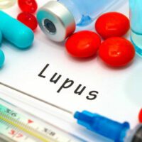 Lupus &#8211; An Overview