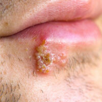 Signs that tell you might have herpes