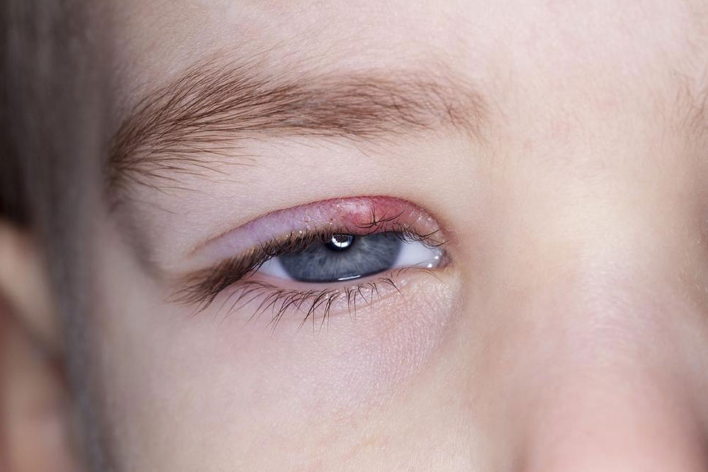 Remedies to get rid of stye