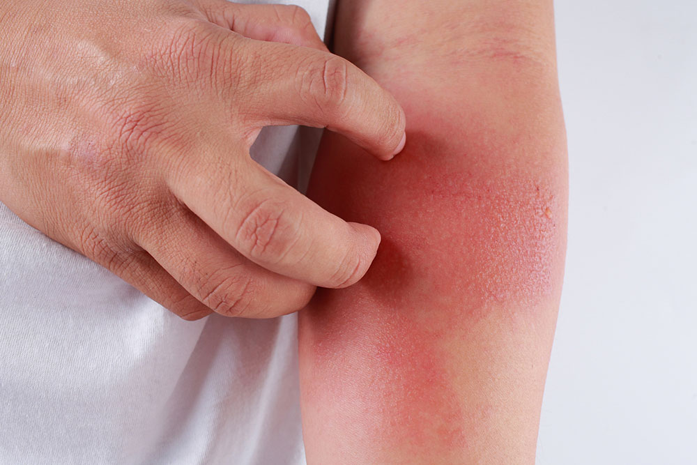 Follow this diet to manage eczema symptoms