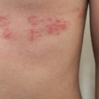 Top 3 Simple Treatments for Shingles You Need to Know