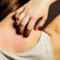 Things You Should Know About Scabies