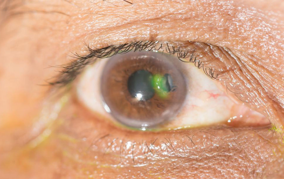 Various eye diseases and their symptoms