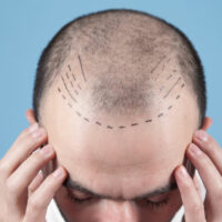 Hair Transplant &#8211; Techniques, Costs, and More